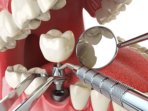 Best Broken or Cracked Tooth Emergency Dentist in Madeira Beach, FL